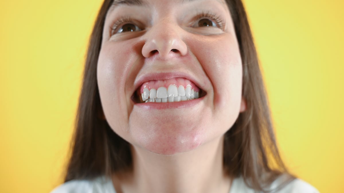 Close-up of young woman smiles broadly, shows her gums, her white, uneven teeth