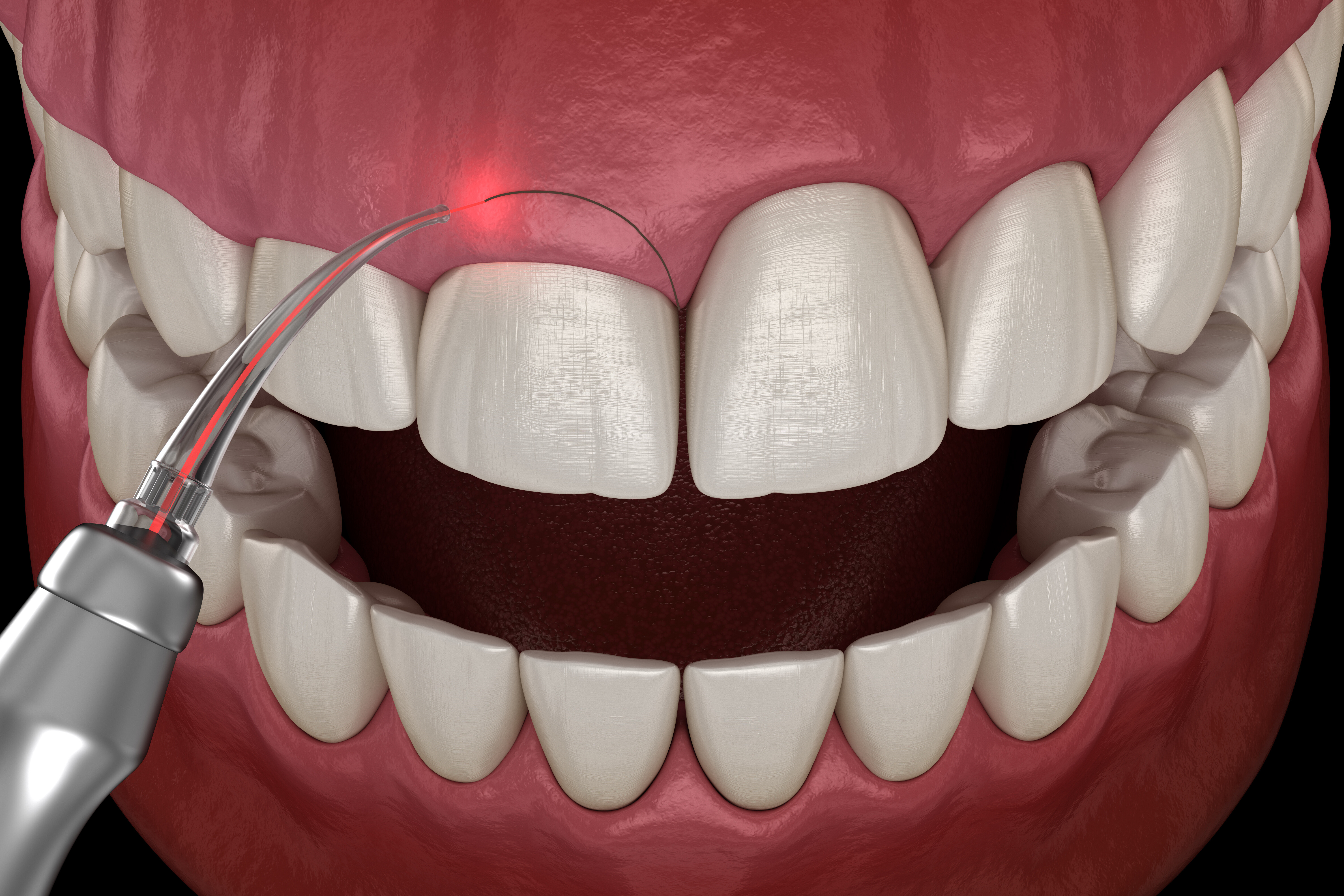 Gingivectomy surgery with laser using. Medically accurate tooth 3D illustration-1