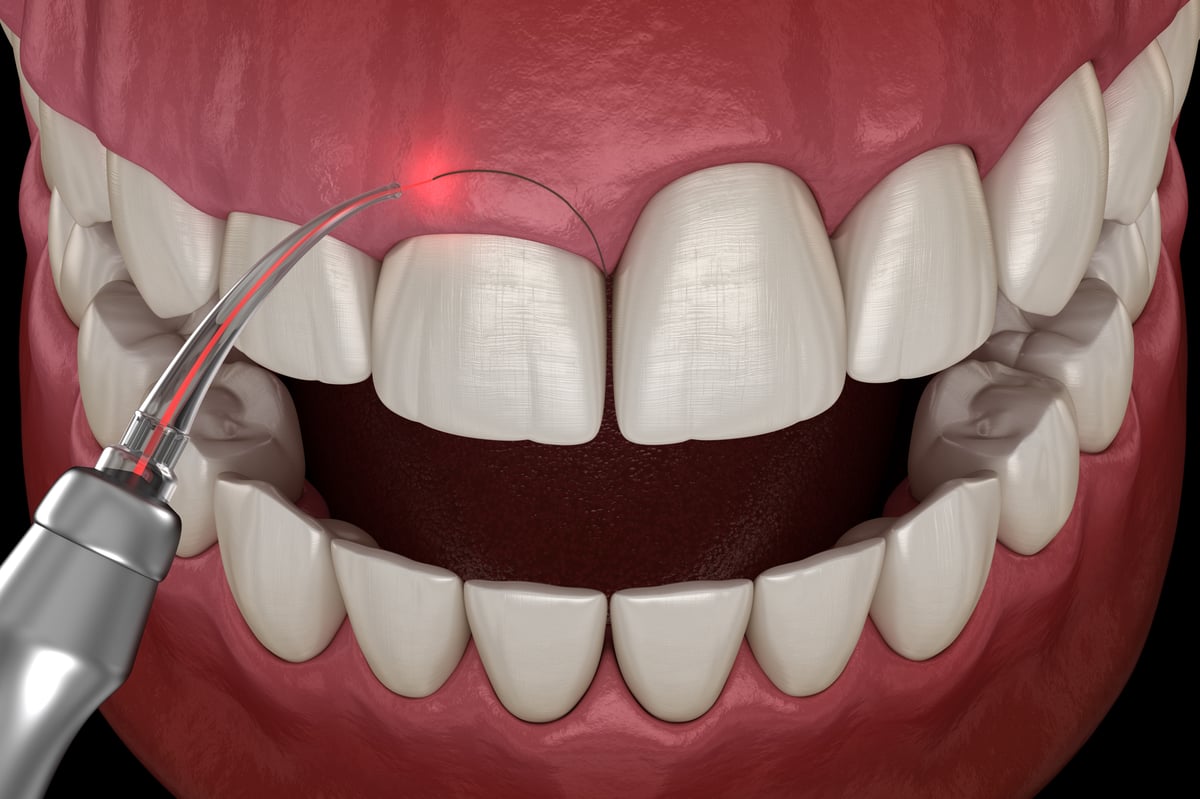 Gingivectomy surgery with laser using. Medically accurate tooth 3D illustration-1