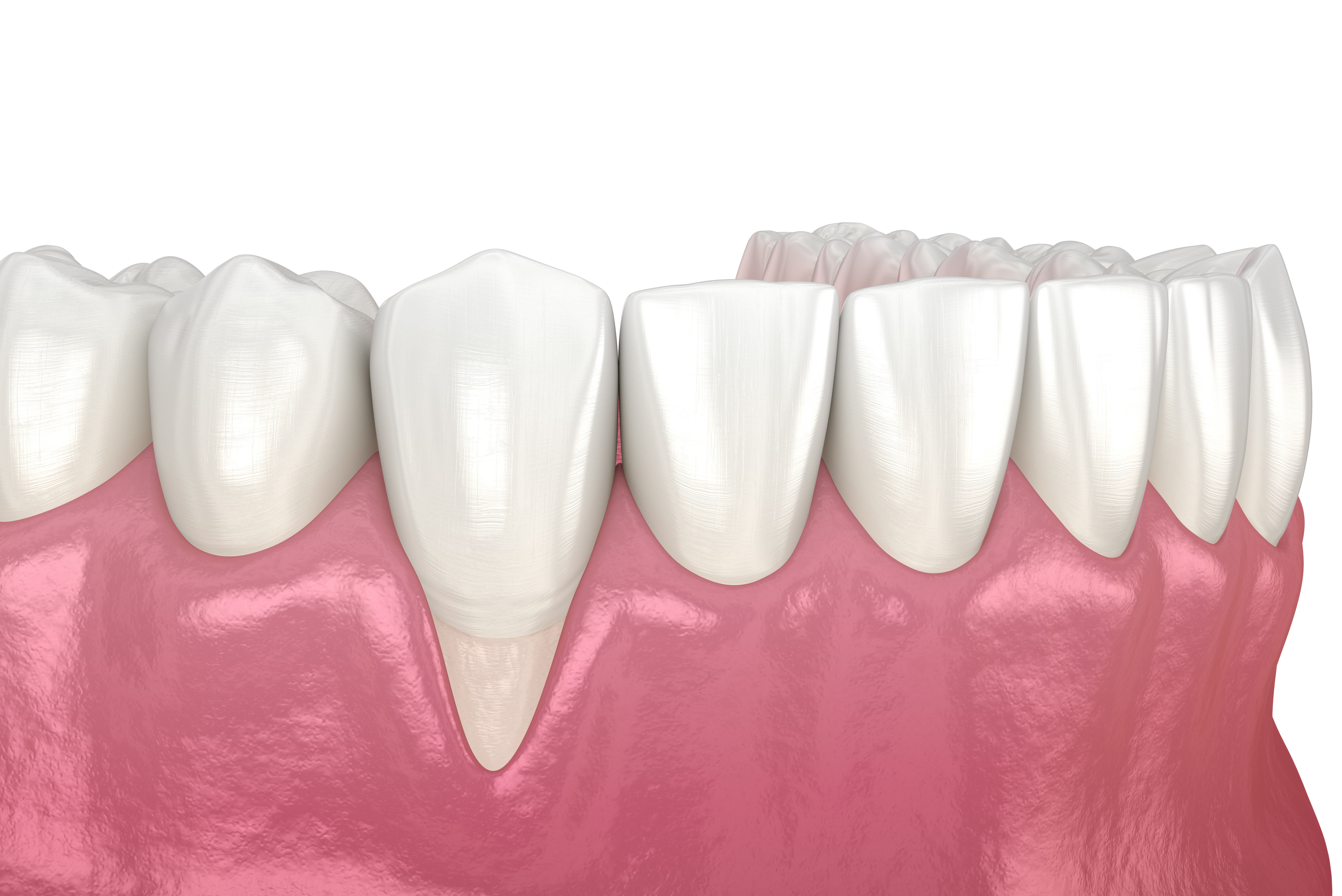 Gum Recession. 3D illustration of Dental problem